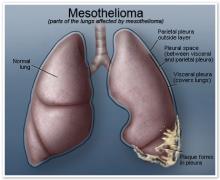 What Is Mesothelioma and What Problems Does Mesothelioma Cause?